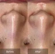 3月限定‼️【毛穴レス角栓除去】✨️￥6050→￥2750※鼻のみ