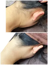 《うなじ脱毛✨》