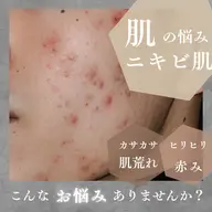 ハーブピーリング