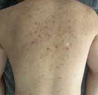 第一印象はお肌で決まる!!メンズにも大人気ハーブピーリング