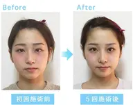 人気No.1💙本場韓国式 小顔コルギ 即実感◎ 90分