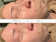 REVIハーブピーリング+エンザイムGを追加🌿ピーリング力UPでより肌荒れしにくい肌へ✨