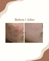 ●大人ニキビ集中ケア（90分）