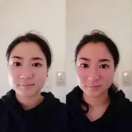 【人気No.１👑】小顔になれる美容鍼《プレミアム美顔コース》▷美顔鍼100本（パルス付）▷姿勢矯正▷美顔矯正▷小顔調整