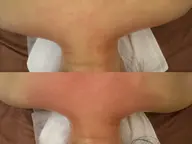 上半身集中ハイパーナイフ+リンパ40分