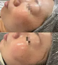 剥けない！即実感ハーブピーリング！