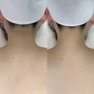 【 脇＋うなじ＋背中上脱毛🫧 】成人式/前撮り/ウエディング/卒業式/入学式