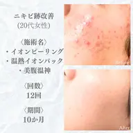 【🧡お得すぎる2回セット🧡】効果を見極めたい人！ピーリング＋Wパック＋ボディケアコース2回分（ニキビに即効性）