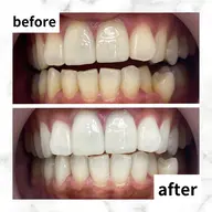 【👑人気No.1👑】5分照射×2回✨照射パワー2倍の最新高速セルフホワイトニングで時短ホワイトニング🦷❣