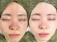 ハーブピーリング+ハイドラ