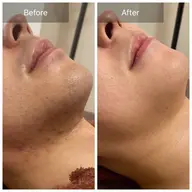 《メンズ脱毛》ヒゲ脱毛　¥3500/回