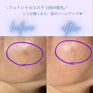 《潤いとトーンアップ✨》フェイシャルエステ