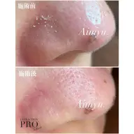 新年度応援価格🌸【毛穴美人コース】🫧毛穴洗浄+ヘッドマッサージ