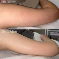 【二の腕のぶつぶつ】剥けないハーブピーリング/ピーリング力UPのオプション付き！通常15,400円→11,000円