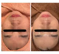 【毛穴＆たるみエイジングケア】プレミアム美容液導入