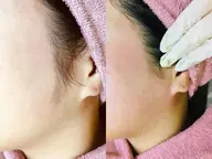 顔ワックス脱毛