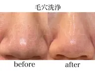 気になる黒ずみ毛穴に✨毛穴洗浄+韓国肌管理