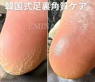 韓国式足裏角質ケア