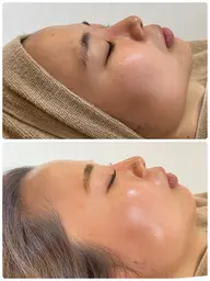 溶ける糸リフト＆塗るボトックス