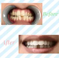 【ミニモ新規限定】メディアで話題✨セルフホワイトニング通常コース8分x2 【すぐ予約対象外】