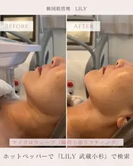 大人気！エステ版オンダリフト×AHAハーブピーリング　¥36000→