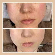 光フェイシャル（肌質改善）