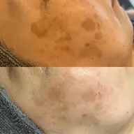 シミケア放題20分➕ラジオ派