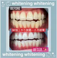 【歯本来の白さmaxまで一気に制限なく目指したい方、ミニモ限定】ホワイトニングやり放題一ヶ月【すぐ予約対象外】