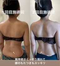 背中が変わるとスルスル痩せる背中深層リンパマッサージ。背中痩せ二の腕痩せ　変化が凄い！ブライダルエステ