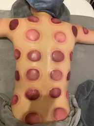 カッピング   30分