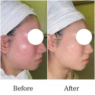 【ほうれい線/目下のたるみ/フェイスライン改善】