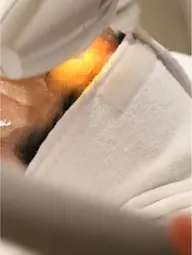 【小顔矯正】顔全体 別人級・切らないリフトアップ!短期間で憧れのVライン形成♪