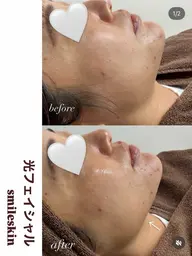光フェイシャルトリートメント