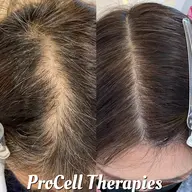 【頭皮改善】無料カウンセリング(薄毛・抜け毛相談)男性🙆🏻♀️プロセルセラピーズ