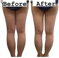 冷凍痩身20カップ‼️✨