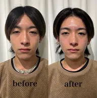 メンズ👨美容鍼【水曜日以外】男性限定!✨美容鍼✨ビフォーアフター頂ける方!特別価格5900円