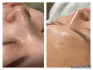 モニター🌸毛穴洗浄!小顔を作る話題の韓国水光肌コース