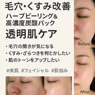 【ニキビ撲滅】剥離なしハーブピーリング×高濃度炭酸｜繰り返す荒れ肌を根本改善。「一生モノ」の陶器肌へ【施術60分】