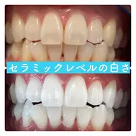 【人気no.1メニュー】ご新規様限定🔥初回体験➕5回来店分チケット🔥白さお約束❣️これで誰でも真っ白な歯に🦷💎