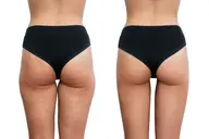 痩身エステ《セルライト解消♯一部位キャビテーション+ラジオ波+EMS&吸引