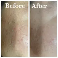 平日限定⭐️ピーリング毛穴エステ💆♂️