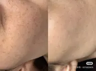 ご新規様限定☘️毛穴洗浄＆DPL光フェシャル