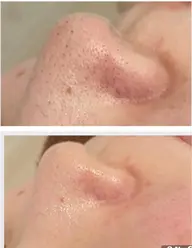 毛穴体験コースクレンジングウォッシングのセルフケアと共にマシーンによる毛穴吸引。たっぷり保湿。潤いたっぷりの肌へ。