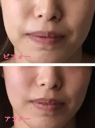 (小顔美容矯正 )他エステメニューと同時予約で¥1000off デコルテ ヘッド込み50分