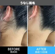 【レディース うなじ脱毛】