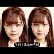 【ミニモ学割U24】イベント前のむくみOFF！小顔美容鍼×EMS