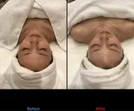 毛穴詰まりに◎【ララピーリング】韓国で話題のピーリング！全顔の施術(+¥500で首も可能)