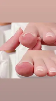 巻き爪ケア（親指2本）｜👉 歩くのがラクになる巻き爪ケア ✨