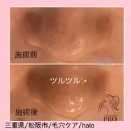 毛穴エクストラクションプロ「毛穴美人コース」Open記念価格