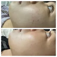 ハーブピーリング